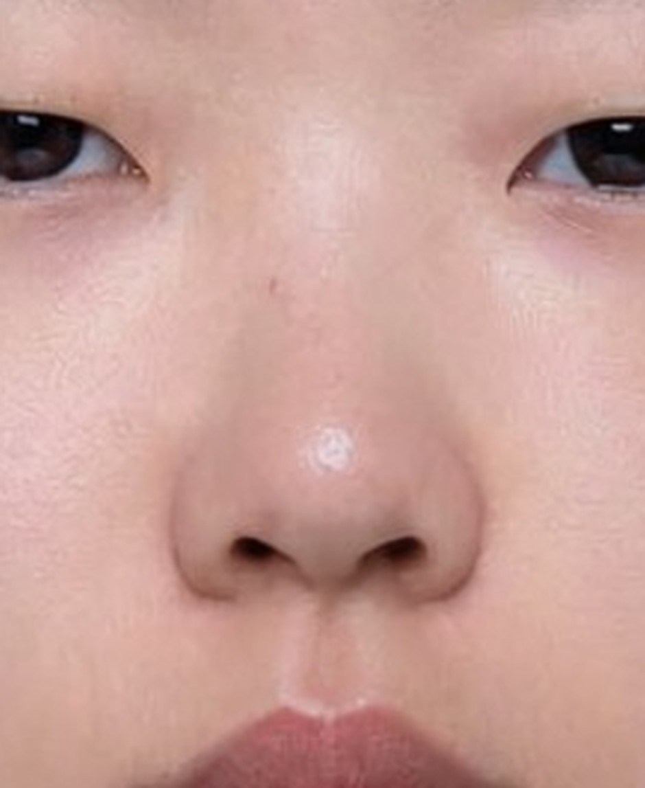 Step 2 — Once more. The line beside the nostrils cleans up.