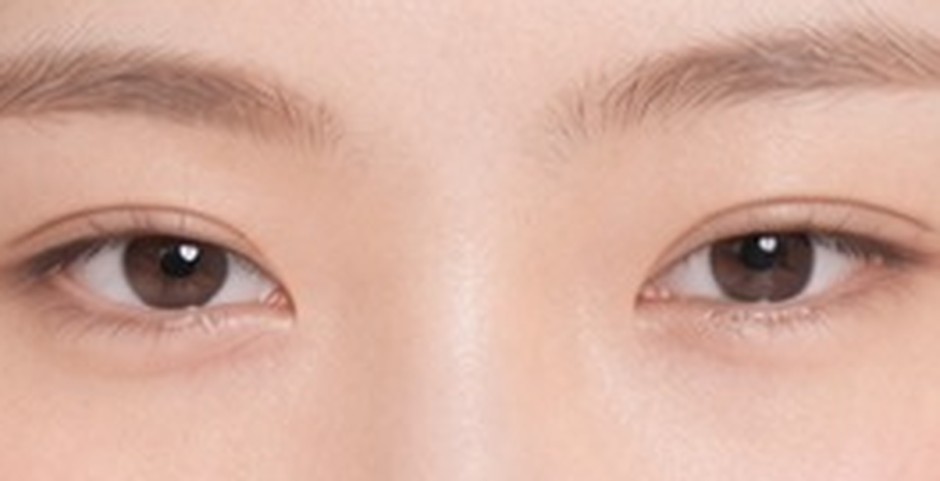 Crease + epicanthoplasty — The inner corners open and the eyes extend toward the front.