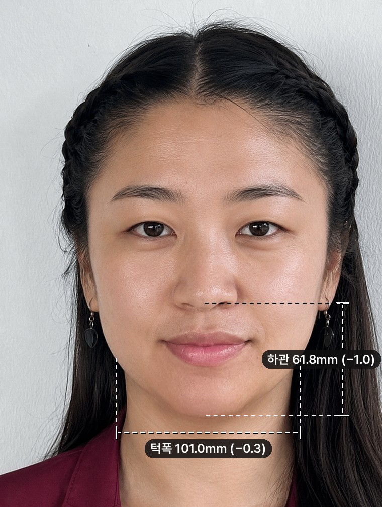1. Chin length — Only the lower face moves, at −1.0mm. Jaw width is nearly unchanged.