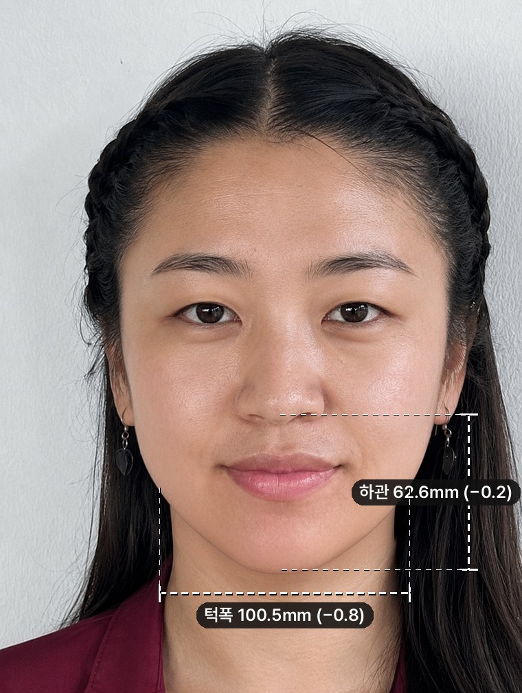 2. + V-line — Jaw width −0.8mm. The lower-face length comes back up slightly.